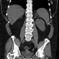 Adrenal myelolipoma (Radiopaedia 8216-9068 non-contrast 12).jpg