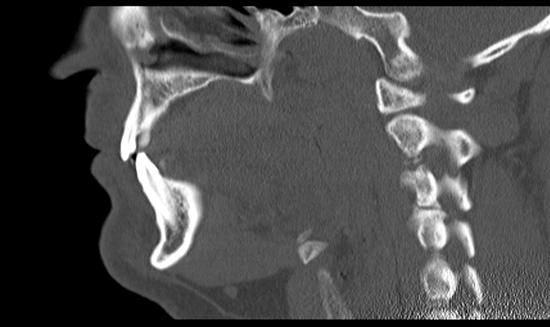 File:Ameloblastoma (Radiopaedia 33677-34806 Sagittal bone window 37).png