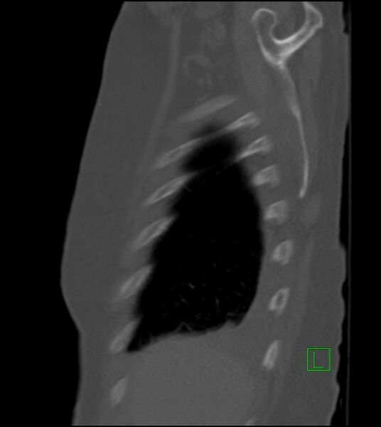 File:Amiodarone deposition in the liver (Radiopaedia 77587-89780 Sagittal bone window 84).jpg