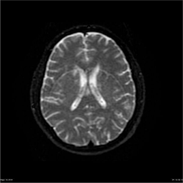 File:Amnestic syndrome secondary to hypoxic brain injury (Radiopaedia 24743-25004 DWI 51).jpg