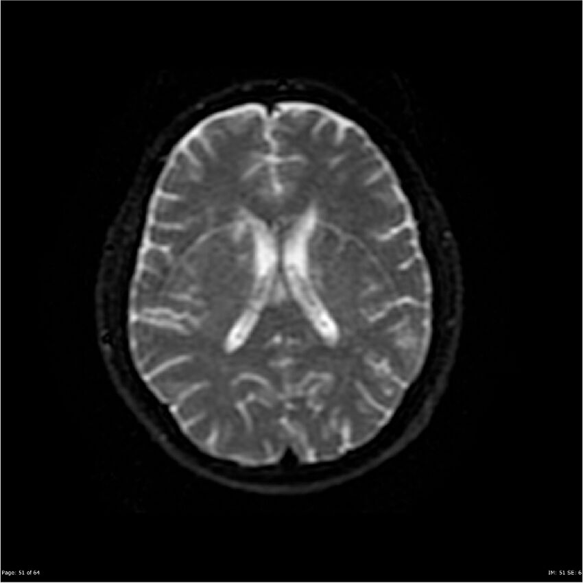 Amnestic syndrome secondary to hypoxic brain injury (Radiopaedia 24743-25004 DWI 51).jpg