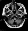 Amyotrophic lateral sclerosis (Radiopaedia 5373-7134 Axial FLAIR 4).jpg