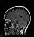 Amyotrophic lateral sclerosis (Radiopaedia 5373-7134 Sagittal FLAIR 7).jpg