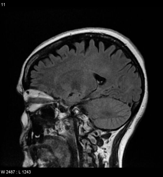 File:Amyotrophic lateral sclerosis (Radiopaedia 5373-7134 Sagittal FLAIR 7).jpg