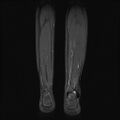 Aneurysmal bone cyst - tibia (Radiopaedia 22343-22367 Coronal STIR 15).jpg