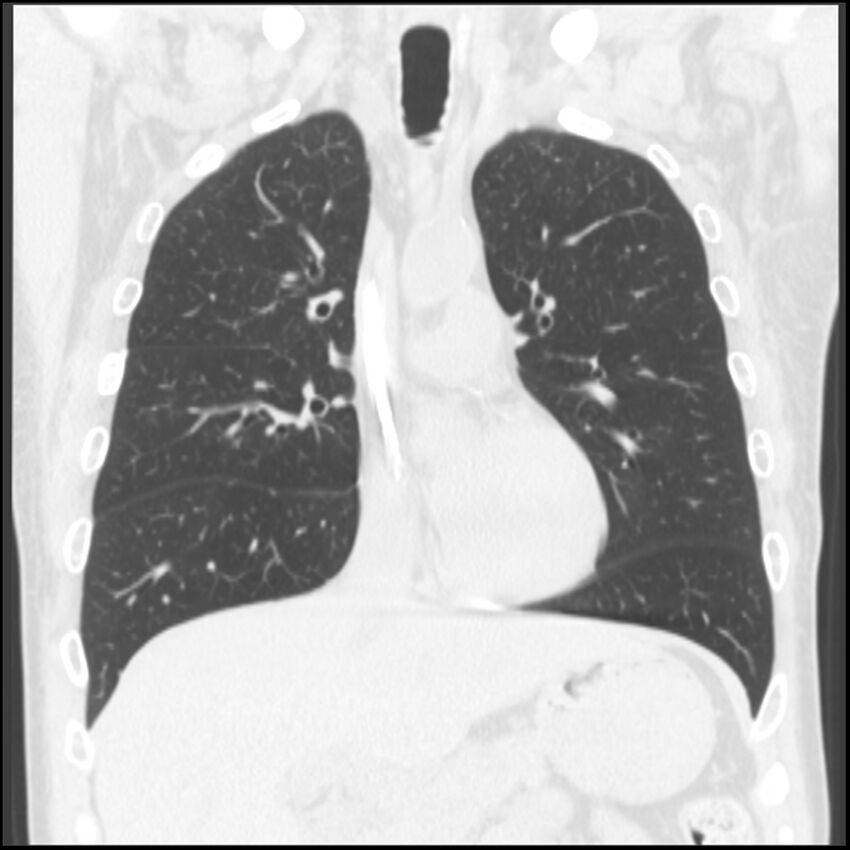 Angioinvasive aspergillosis (Radiopaedia 43957-47466 Coronal lung window 56).jpg
