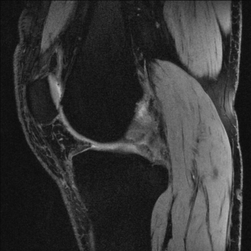Anterior cruciate ligament mucoid degeneration (Radiopaedia 68400-77933 Sagittal 39).jpg