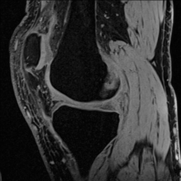 File:Anterior cruciate ligament tear - ramp lesion (Radiopaedia 71883-82322 Sagittal T1 vibe 89).jpg