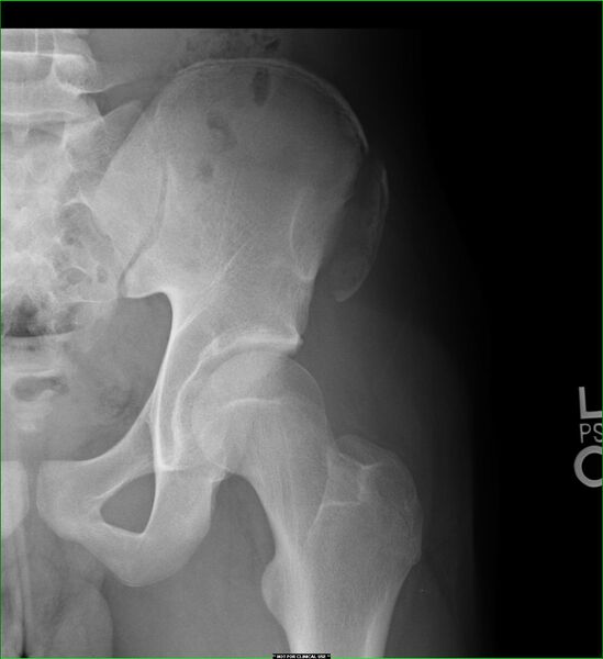 File:Anterior superior iliac spine avulsion (Radiopaedia 38256).jpg