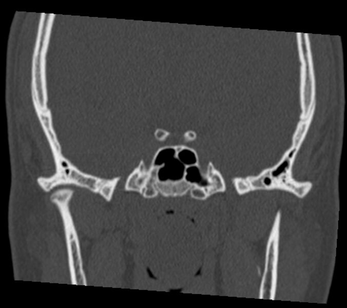 File:Antrochoanal polyp (Radiopaedia 21894-21868 Coronal bone window 32).jpg