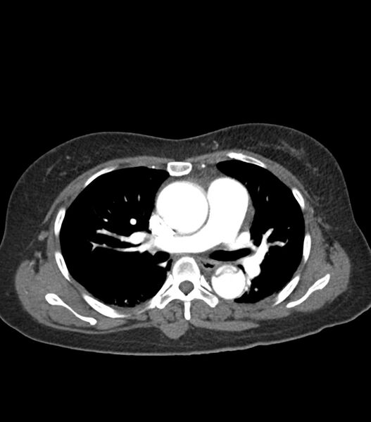 File:Aortic dissection with renal ischemia (Radiopaedia 76573-88338 A 27).jpg