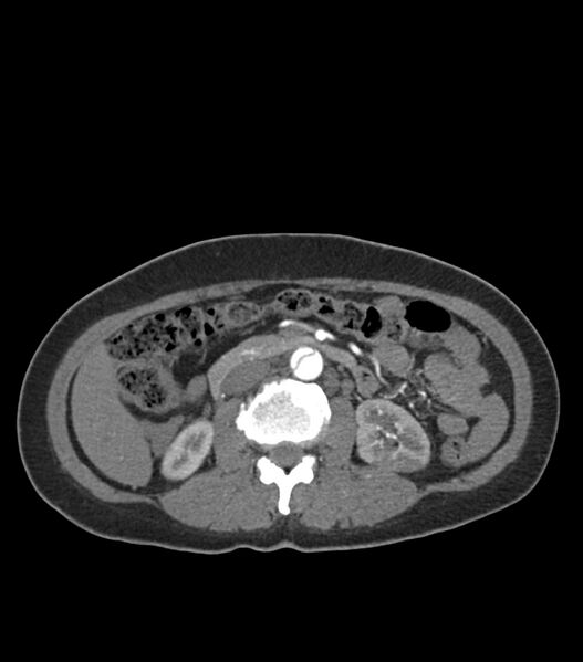 File:Aortic dissection with renal ischemia (Radiopaedia 76573-88338 A 75).jpg