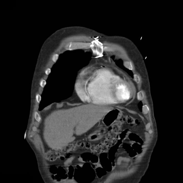 File:Aortic dissection with rupture into pericardium (Radiopaedia 12384-12647 B 4).jpg