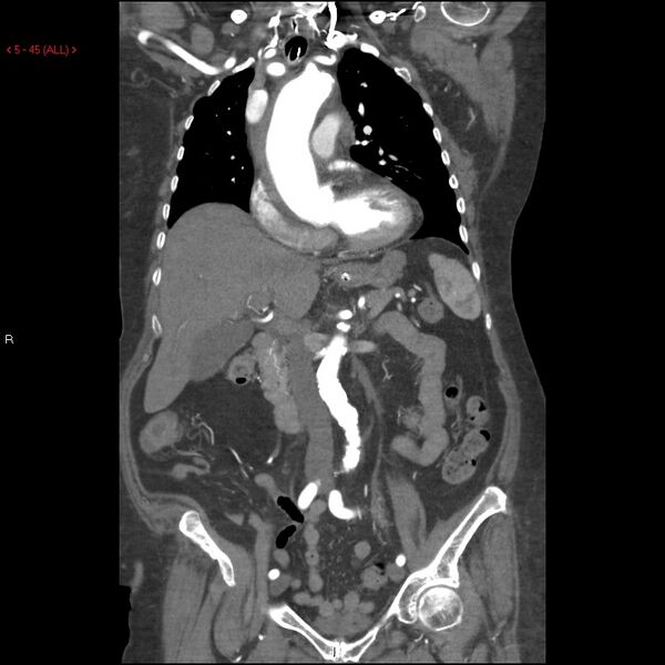 File:Aortic intramural hematoma (Radiopaedia 27746-28001 B 22).jpg