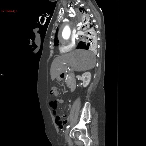 File:Aortic intramural hematoma (Radiopaedia 27746-28001 C 14).jpg