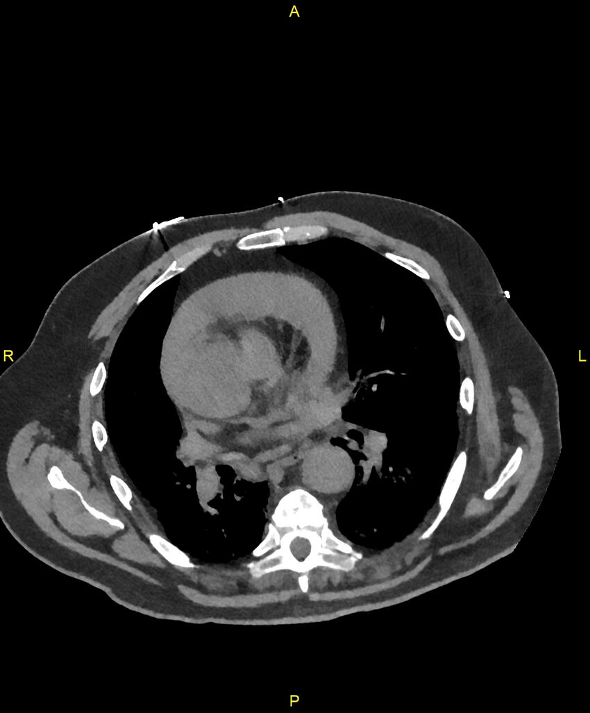 Aortic rupture (Radiopaedia 88822-105594 Axial non-contrast 112).jpg