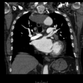 Aorto-coronary bypass graft aneurysms (Radiopaedia 40562-43157 B 24).png