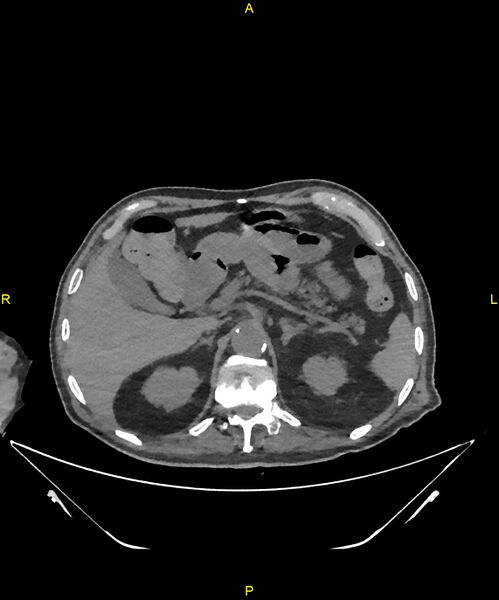 File:Aortoenteric fistula (Radiopaedia 84308-99603 Axial non-contrast 81).jpg