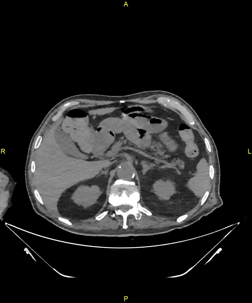 Aortoenteric fistula (Radiopaedia 84308-99603 Axial non-contrast 81).jpg