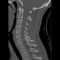 Apical pneumothorax on cervical spine CT (Radiopaedia 45343-49368 Sagittal bone window 17).jpg