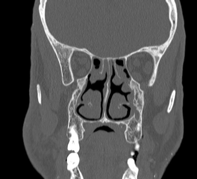File:Aplastic maxillary sinuses (Radiopaedia 60030-67561 Coronal non-contrast 22).jpg