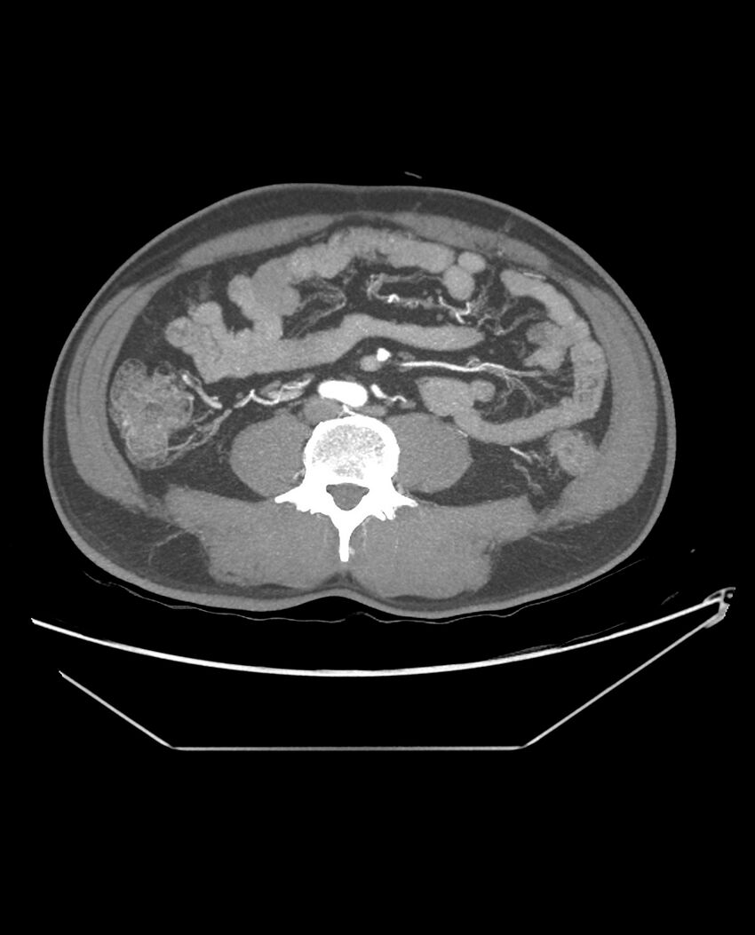 Aplastic posterior tibial arteries (Radiopaedia 84021-99249 A 67).jpg