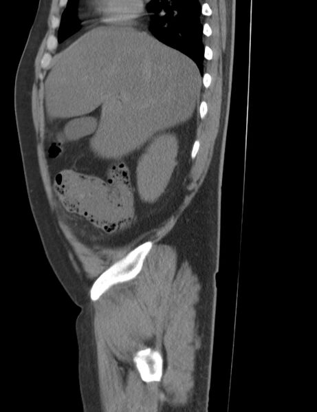 File:Appendicitis and giant appendicolith (Radiopaedia 80251-93588 C 5).jpg
