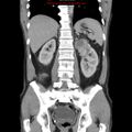 Appendicitis and renal cell carcinoma (Radiopaedia 17063-16760 B 21).jpg