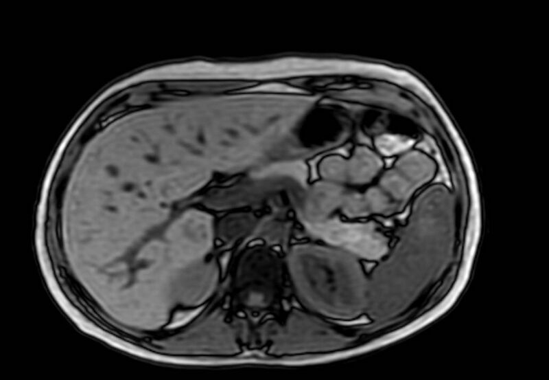 File:Appendicitis in gravida (MRI) (Radiopaedia 89433-106395 D 15).jpg