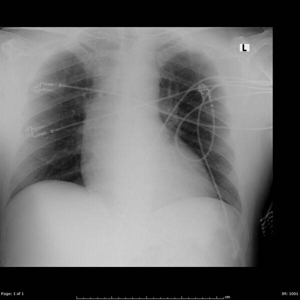 File:Ascending aortic aneurysm (Radiopaedia 50086-55403 Frontal 1).jpg