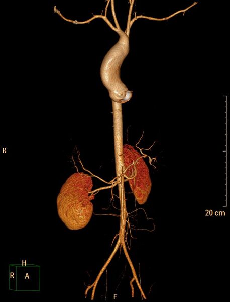 File:Ascending aortic pseudoaneurysm (Radiopaedia 28638-28910 D 1).jpg