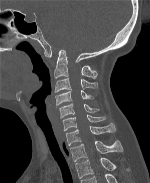 File:Atlanto-occipital assimilation with basilar invagination (Radiopaedia 70122-80188 Sagittal bone window 64).jpg