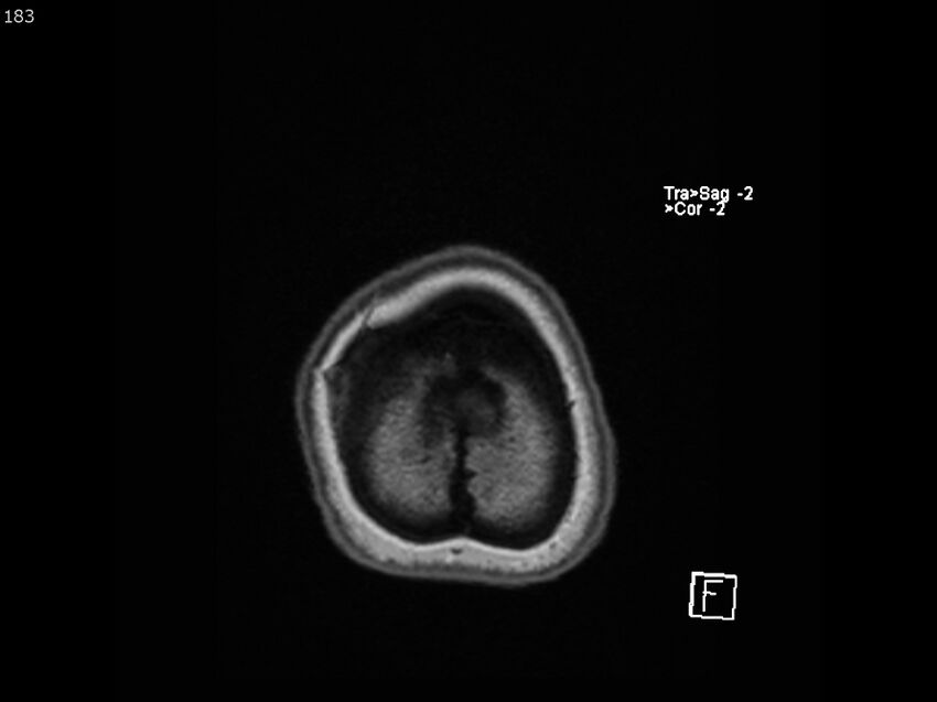 Atypical meningioma - intraosseous (Radiopaedia 64915-74572 Axial T1 183).jpg