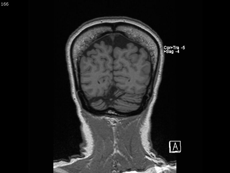File:Atypical meningioma - intraosseous (Radiopaedia 64915-74572 Coronal T1 166).jpg