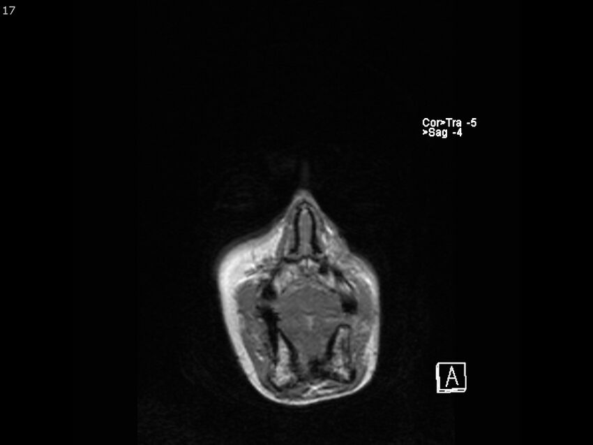 Atypical meningioma - intraosseous (Radiopaedia 64915-74572 Coronal T1 17).jpg