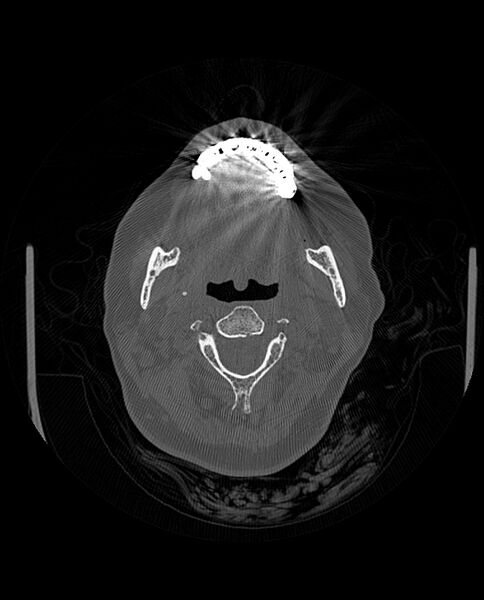 File:Automastoidectomy with labyrinthine fistula (Radiopaedia 84143-99411 Axial non-contrast 8).jpg