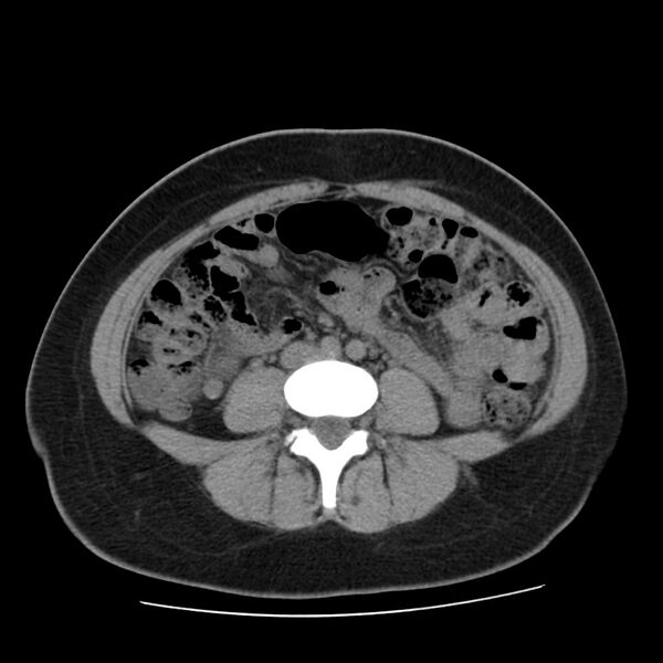 File:Autosomal dominant polycystic kidney disease (Radiopaedia 23061-23093 Axial non-contrast 40).jpg