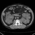 Autosomal dominant polycystic kidney disease (Radiopaedia 36539-38101 Axial non-contrast 40).jpg