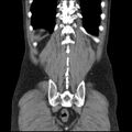 Autosomal dominant polycystic kidney disease (Radiopaedia 36539-38101 C 58).jpg