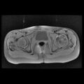 Avascular necrosis of the hip (Radiopaedia 29563-30067 Axial T1 fat sat 9).jpg