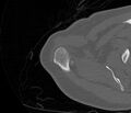 Avulsion fracture - greater tuberosity of humerus (Radiopaedia 71216-81514 Axial bone window 14).jpg