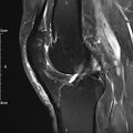 Avulsion fracture of the fibular head (Radiopaedia 74804-85808 Sagittal PD fat sat 19).jpg