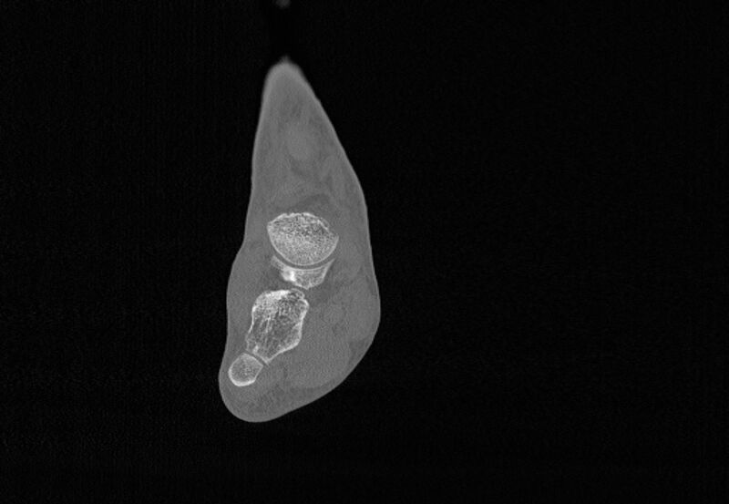 File:Avulsion fractures of talus and calcaneus (Radiopaedia 48277-53155 Coronal bone window 41).jpg