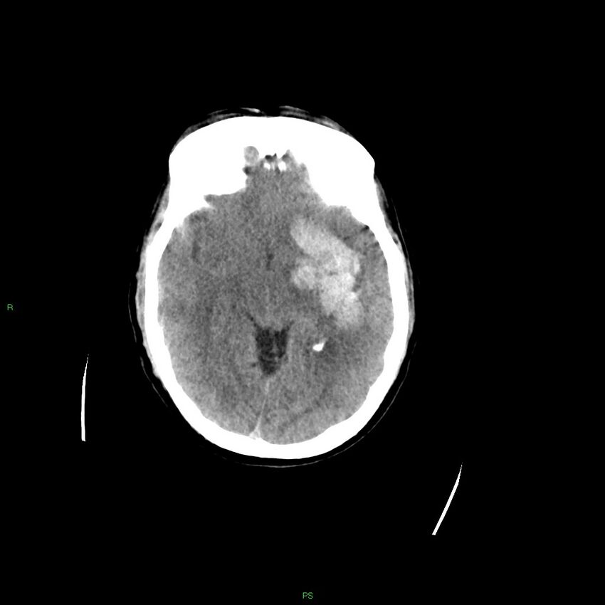Basal ganglia hemorrhage (Radiopaedia 58349-65472 Axial non-contrast 34).jpg
