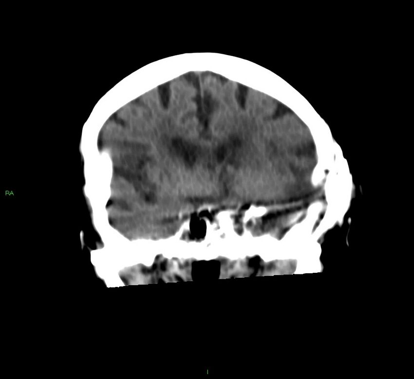 Basal ganglia hemorrhage (Radiopaedia 58790-66024 Coronal non-contrast 38).jpg