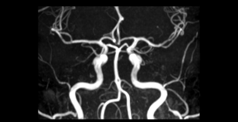 File:Basilar artery fenestration (Radiopaedia 74537-85455 3D TOF MIP MRA 1).jpg