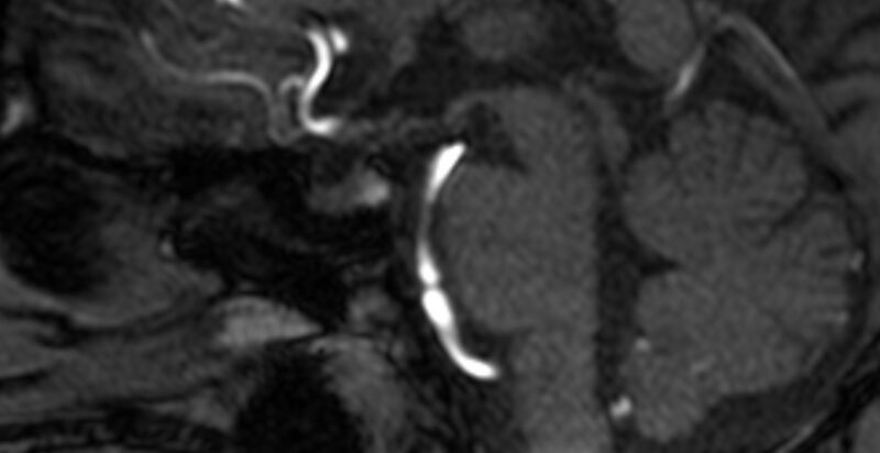File:Basilar artery fenestration (Radiopaedia 74537-85455 Sagittal MRA TOF 18).jpg