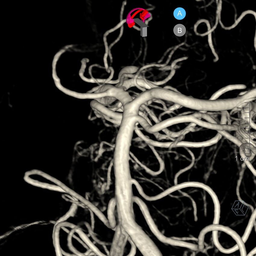 Basilar artery perforator aneurysm (Radiopaedia 82455-97734 3D view left VA 105).jpg