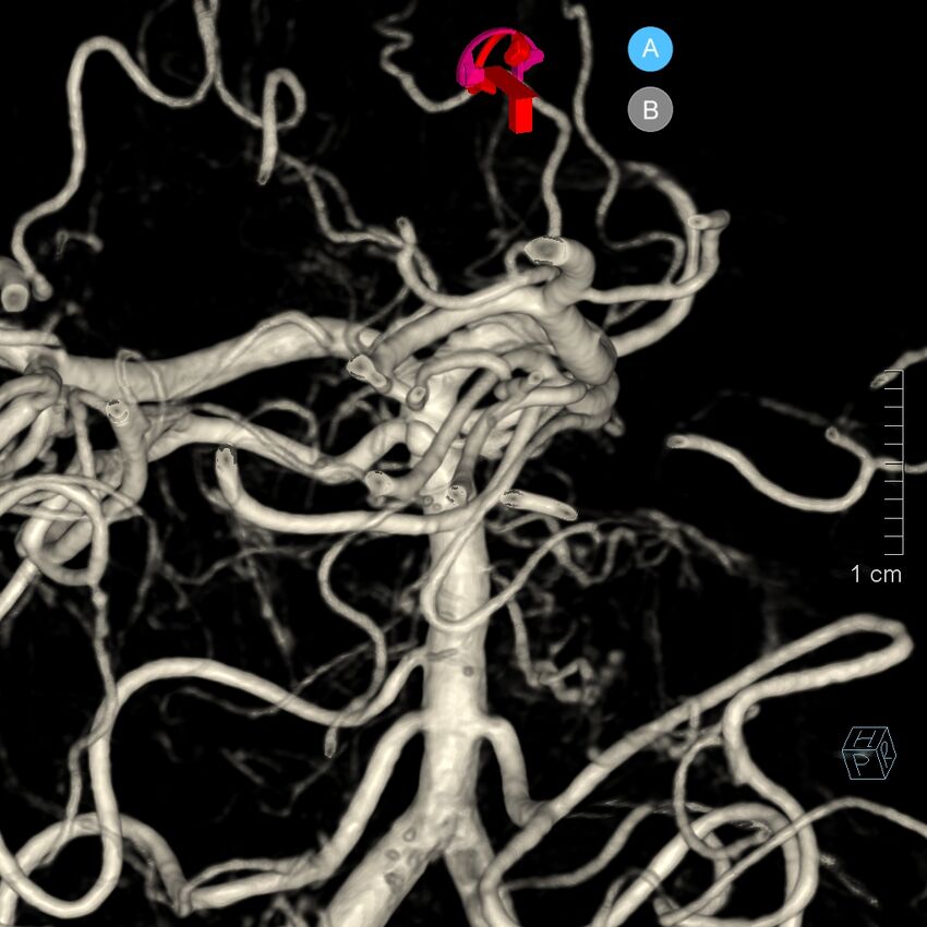 Basilar artery perforator aneurysm (Radiopaedia 82455-97734 3D view left VA 153).jpg