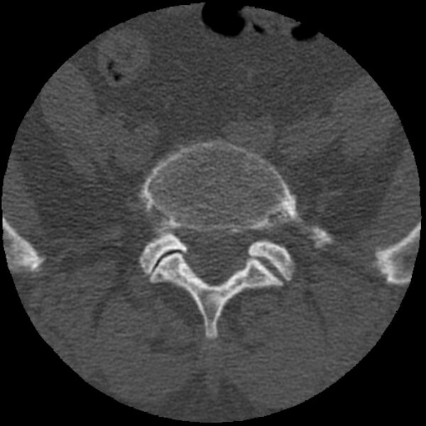File:Bertolotti syndrome (Radiopaedia 24864-25128 Axial bone window 1).jpg
